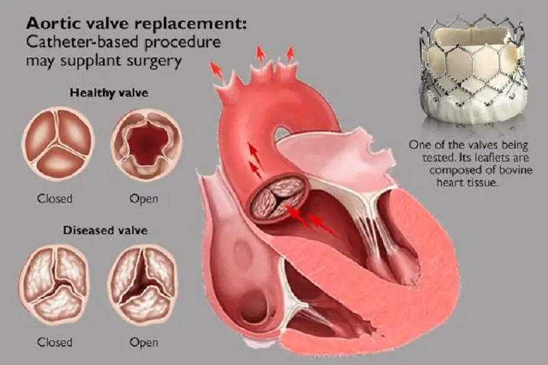 Aortic valve replacement