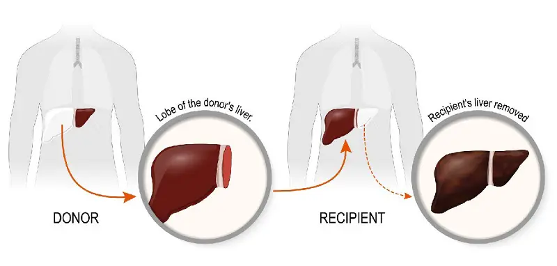 Liver transplant