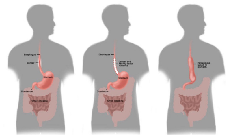 Partial removal of the esophagus