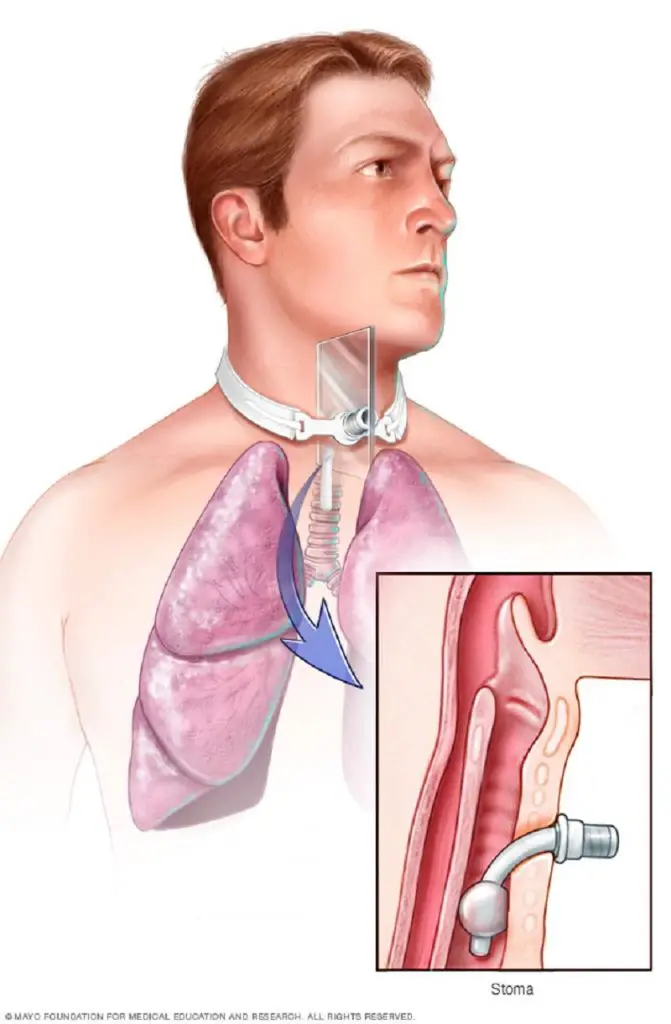 Tracheostomy