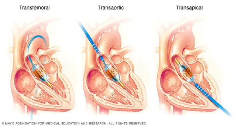 Transcatheter Aortic Valve Replacement